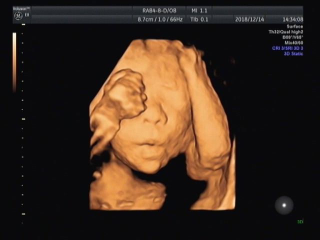 胎兒四維超聲檢查.jpg 胎兒四維超聲檢查.jpg