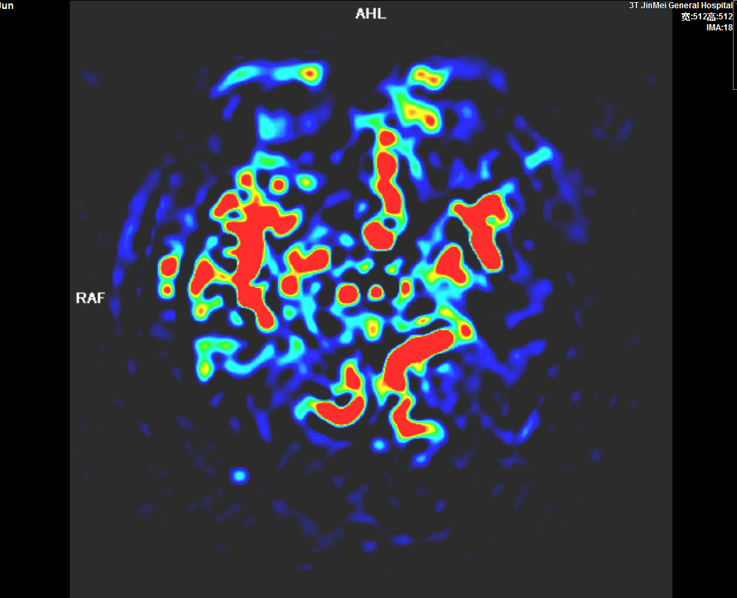 頭顱灌注成像ASL.PNG 頭顱灌注成像ASL.PNG