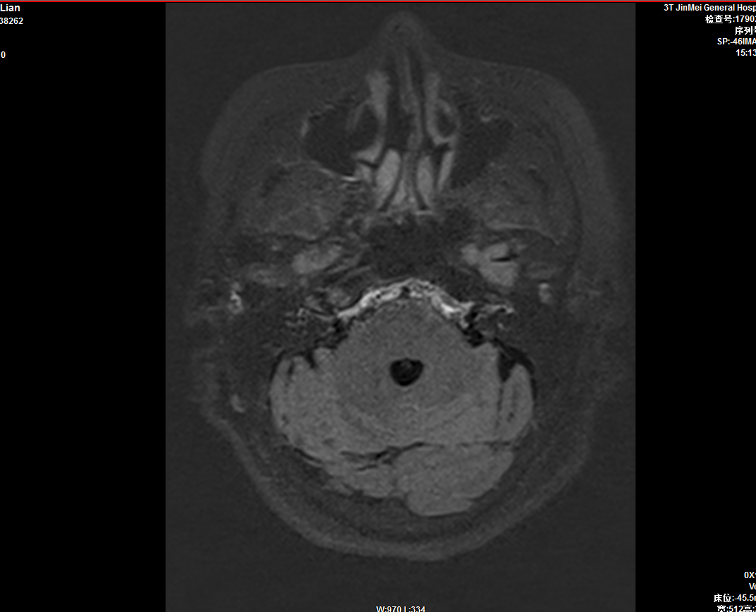 內(nèi)耳釓造影.PNG 內(nèi)耳釓造影.PNG