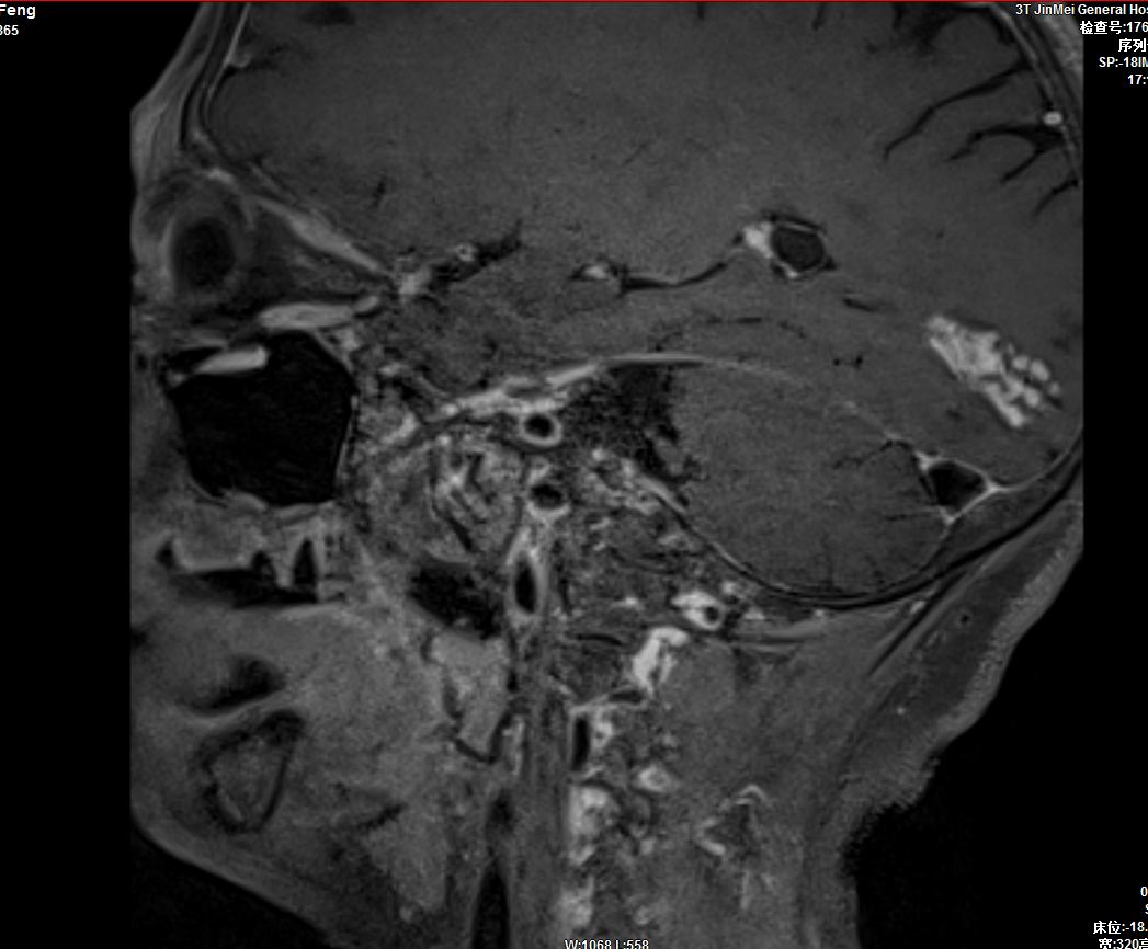 血管高分辨成像.PNG 血管高分辨成像.PNG