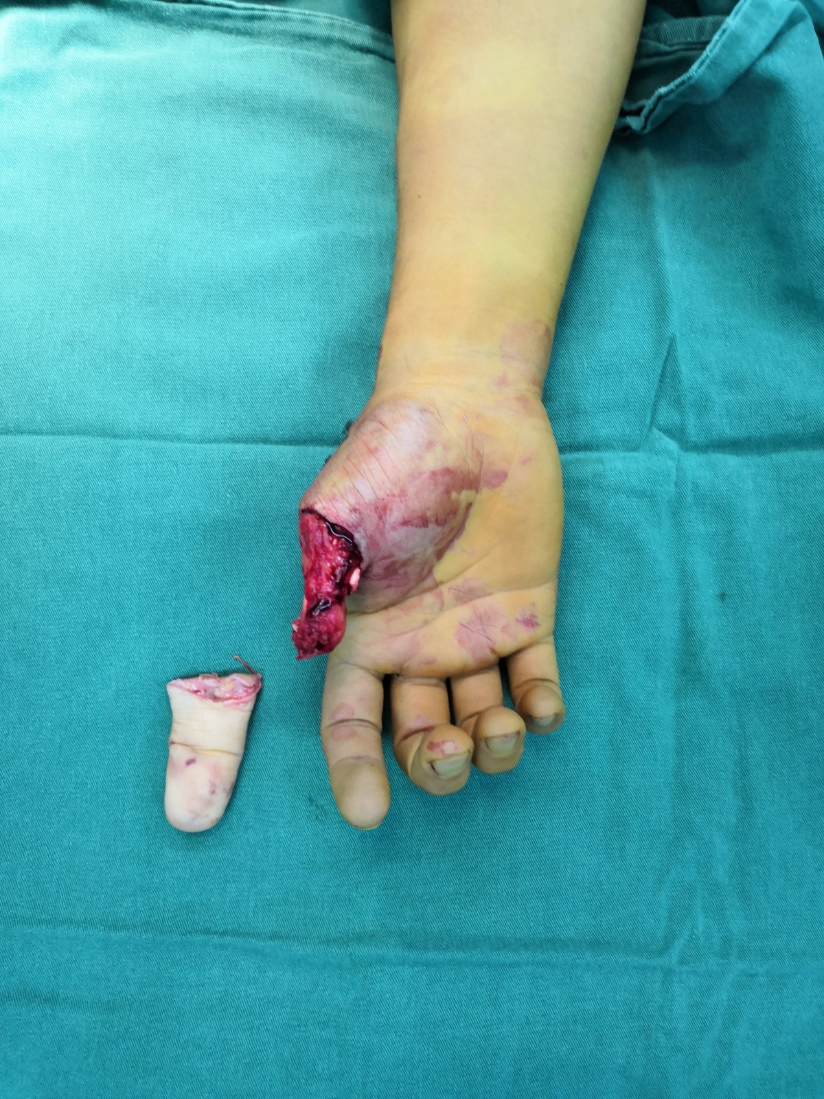 斷指再植1.jpg 斷指再植1.jpg