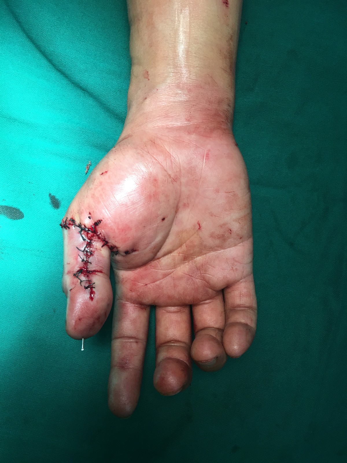 斷指再植2.jpg 斷指再植2.jpg