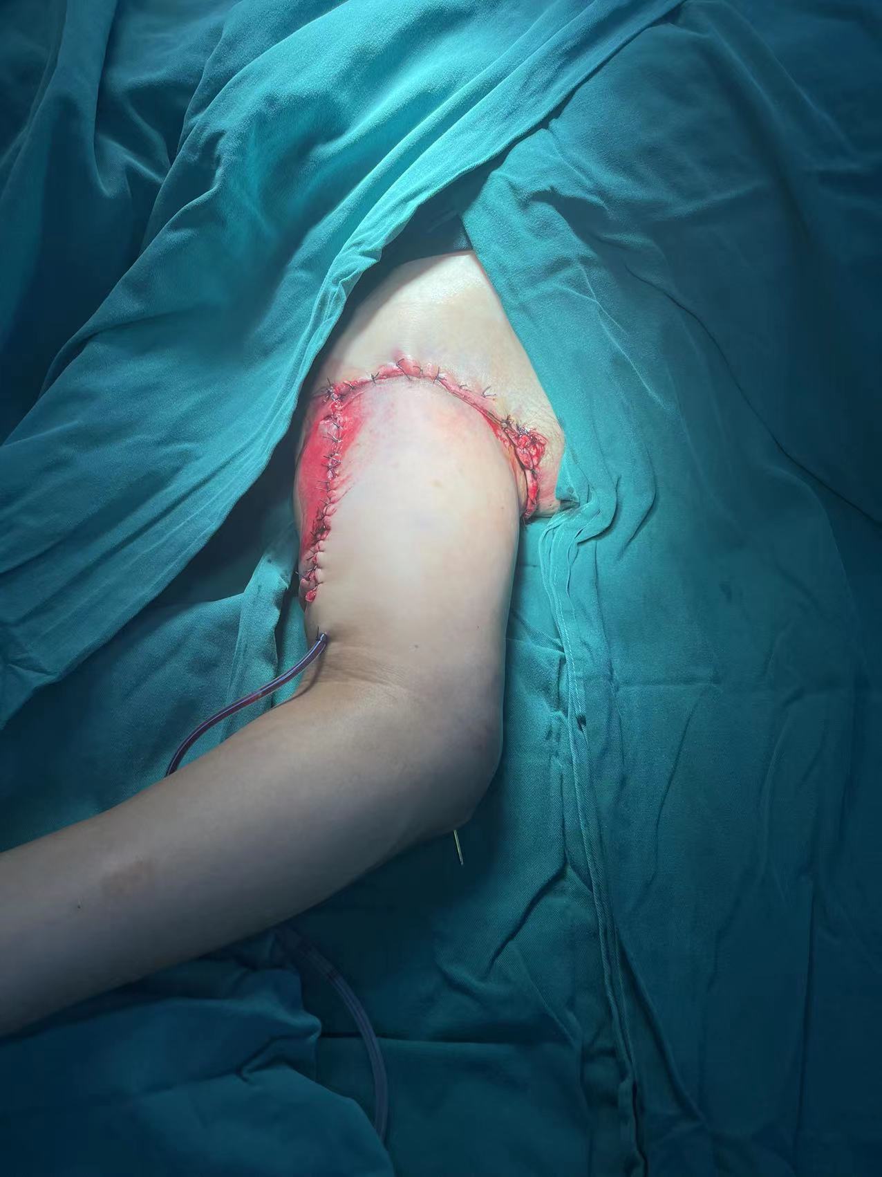 斷肢再植1.jpg 斷肢再植1.jpg