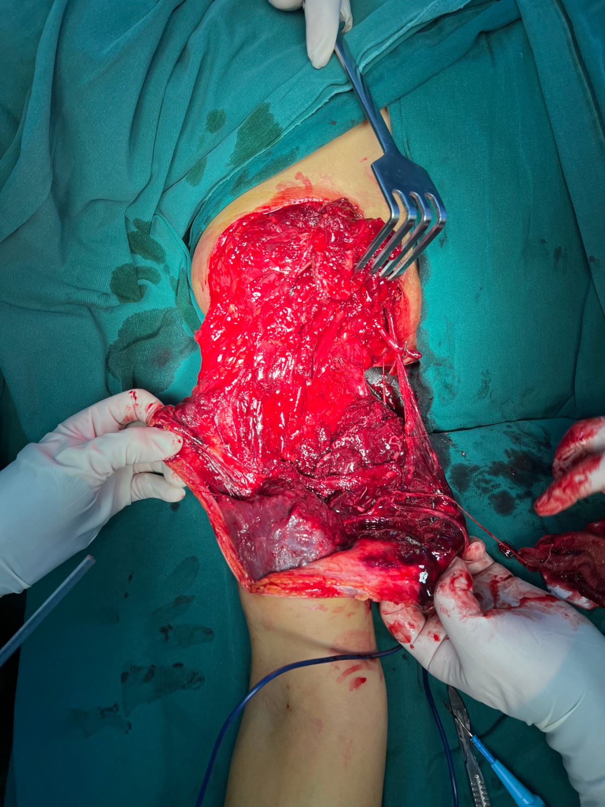 斷肢再植2.jpg 斷肢再植2.jpg