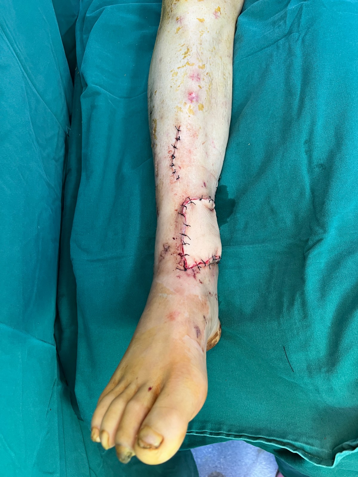 游離皮瓣修復(fù)骨外露創(chuàng)面4.jpg 游離皮瓣修復(fù)骨外露創(chuàng)面4.jpg