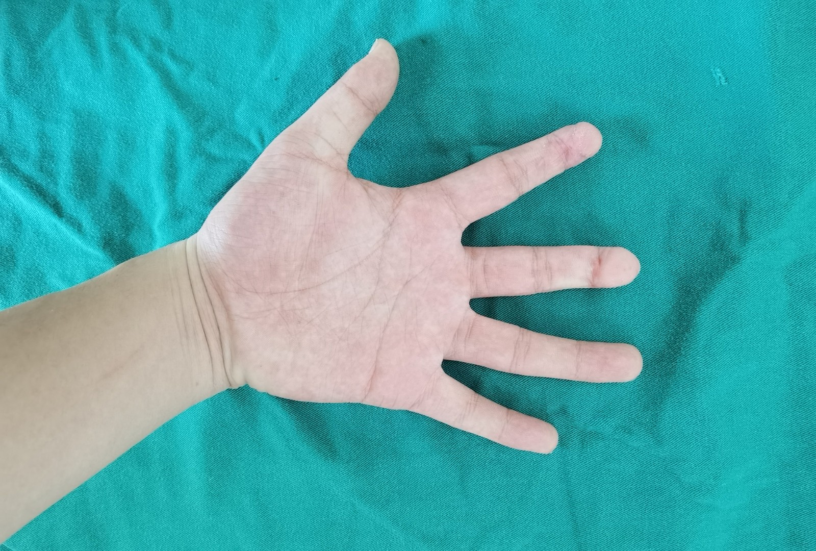 手指再造2.jpg 手指再造2.jpg