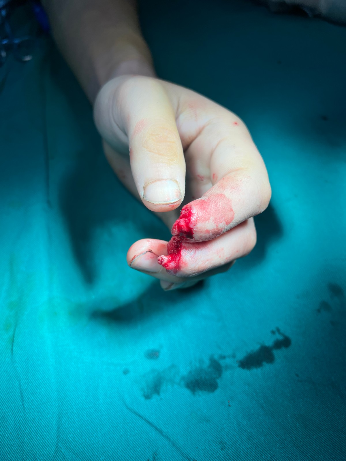 手指再造3.jpg 手指再造3.jpg