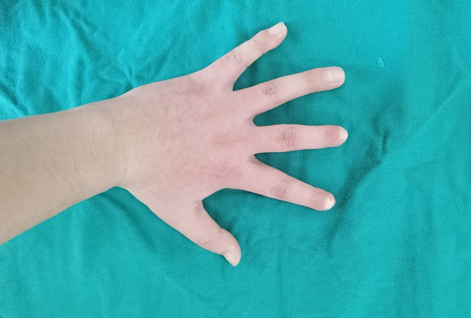 手指再造1.jpg 手指再造1.jpg