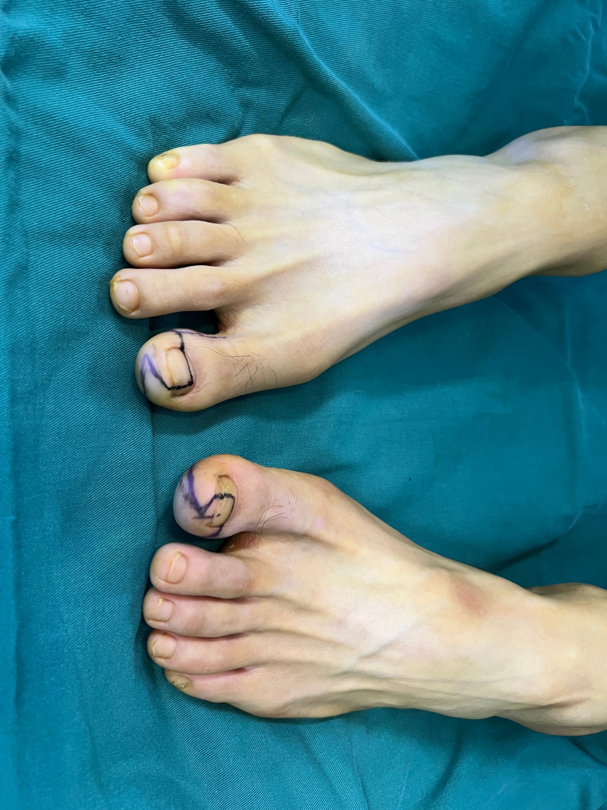 手指再造4.jpg 手指再造4.jpg