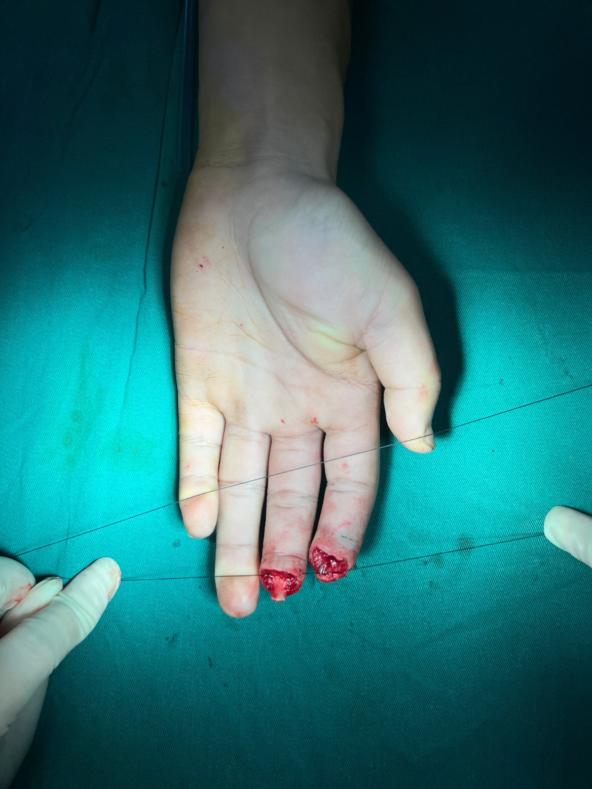 手指再造5.jpg 手指再造5.jpg