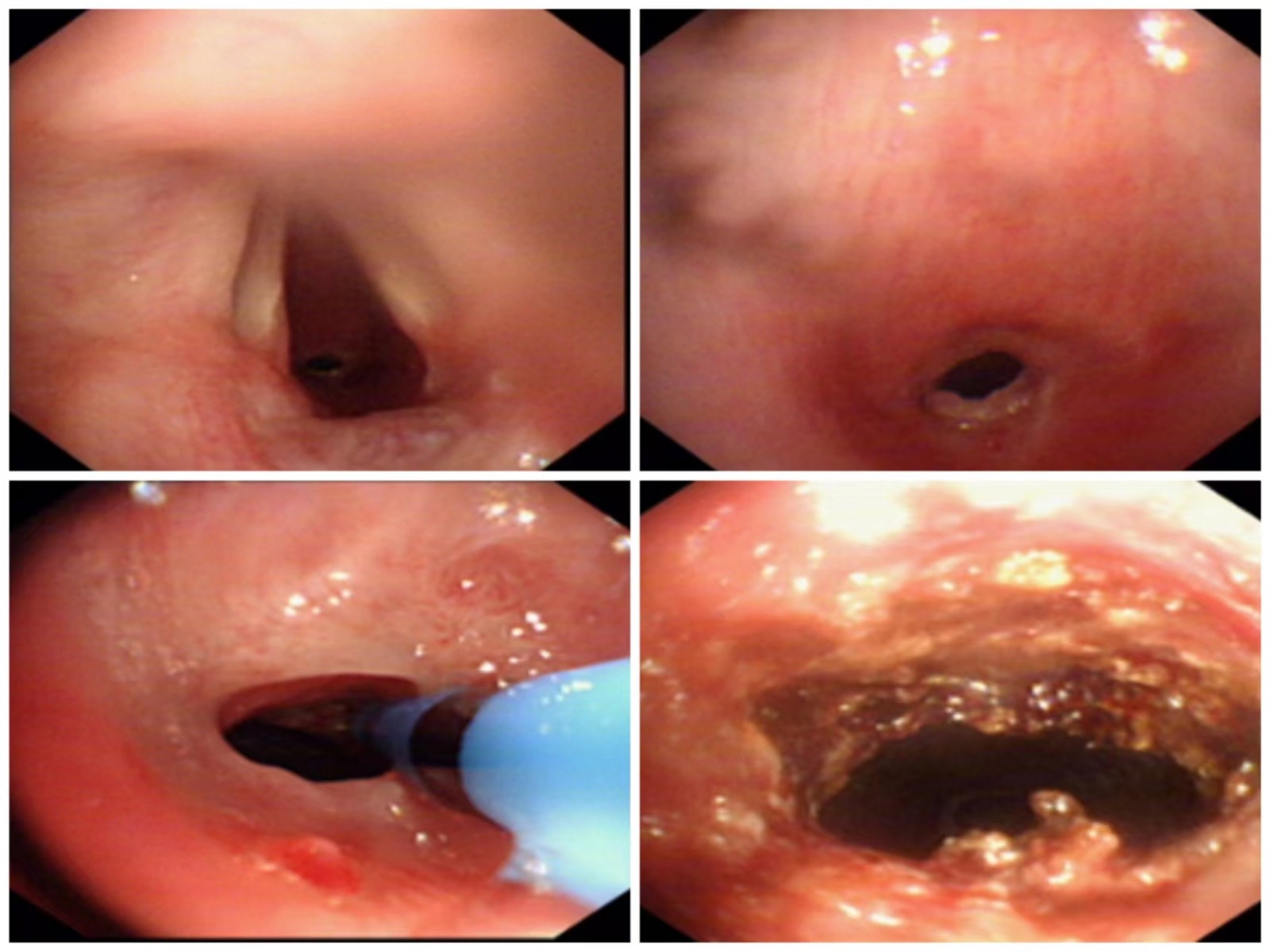 氬氣刀治療.jpg 氬氣刀治療.jpg