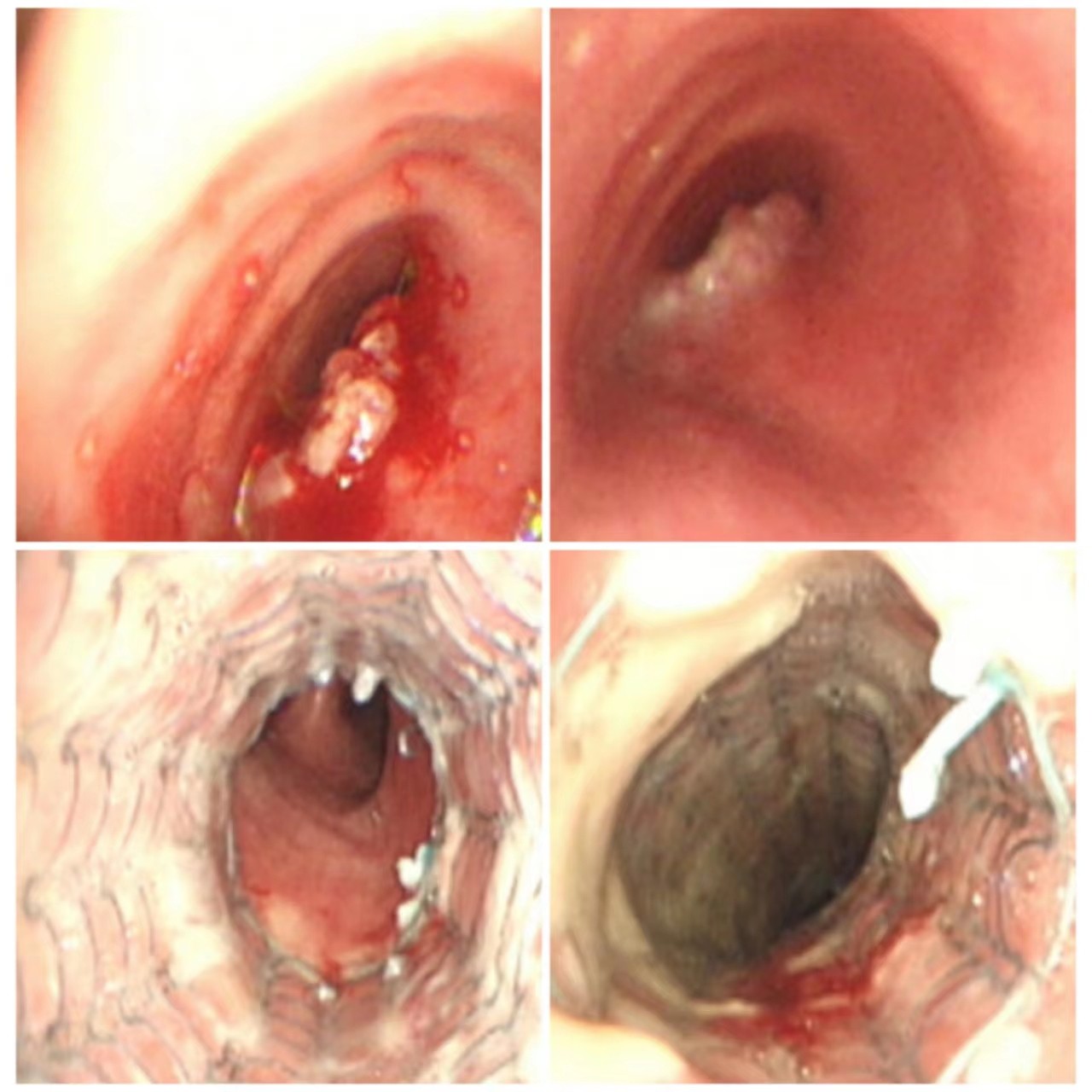 直筒支架置入.jpg 直筒支架置入.jpg